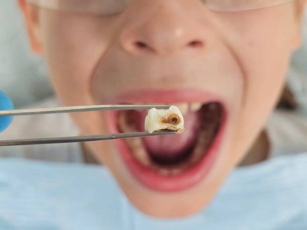 Best Emergency Dentist for Lost Fillings or Crowns in Hampton Beach, NH